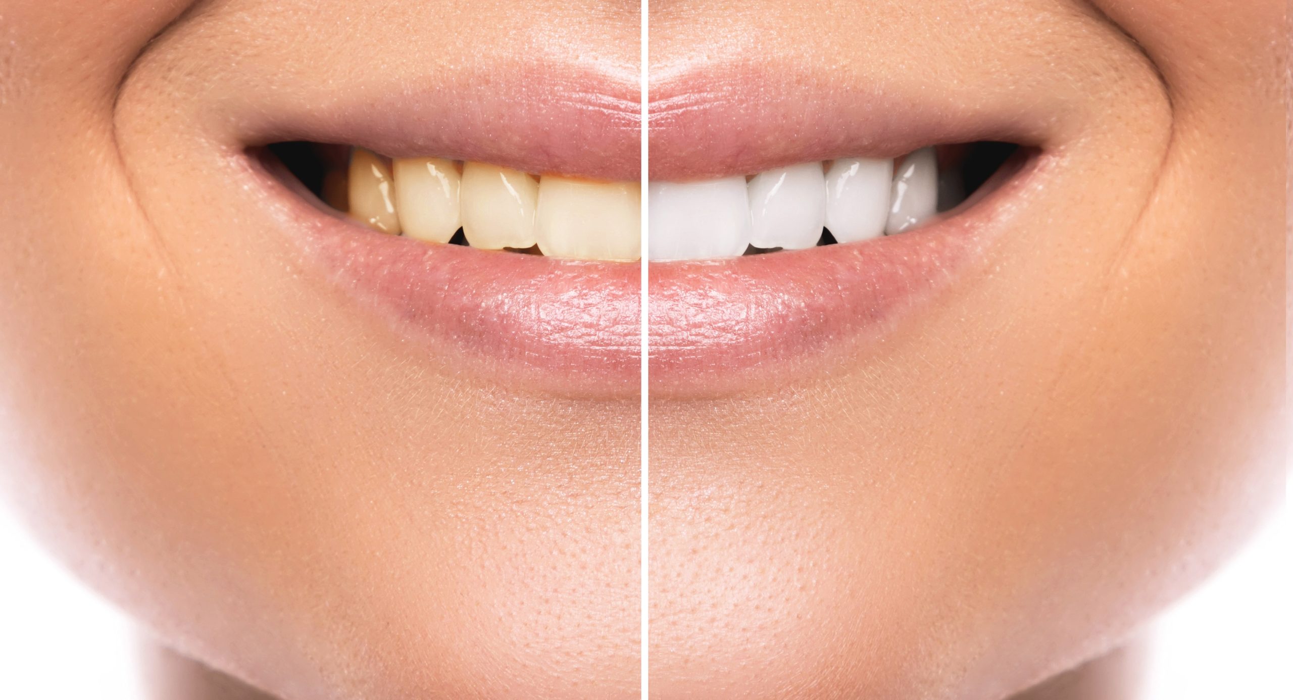 Professional Teeth Whitening in Surrey