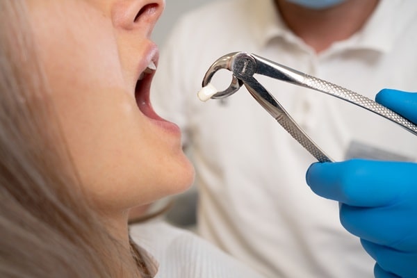 Tooth Extraction in Surrey Central