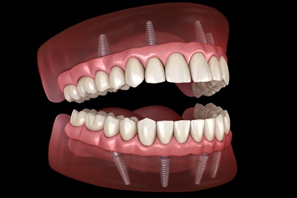 all-on-4-dental-implants-lin-surrey