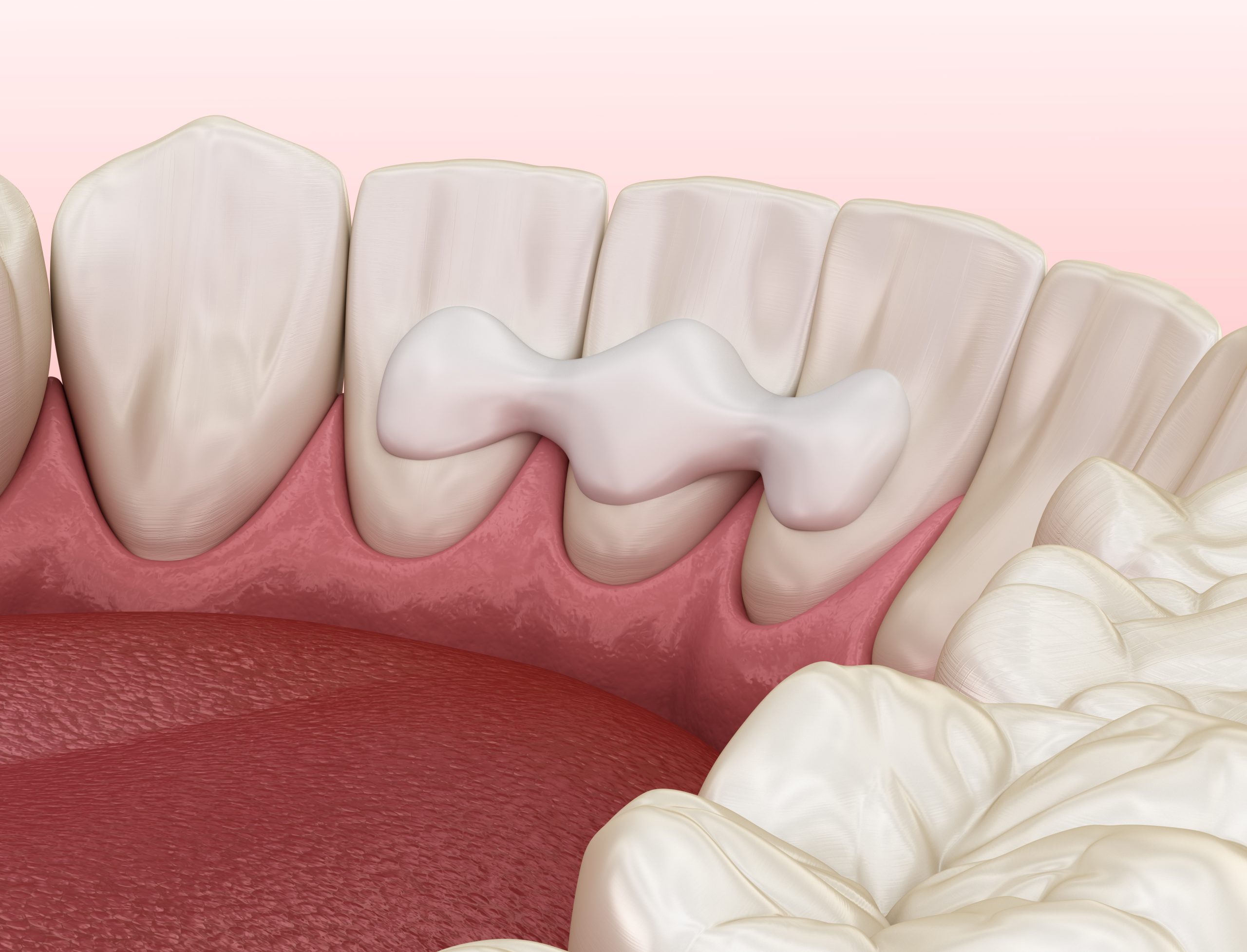 dental-bonding
