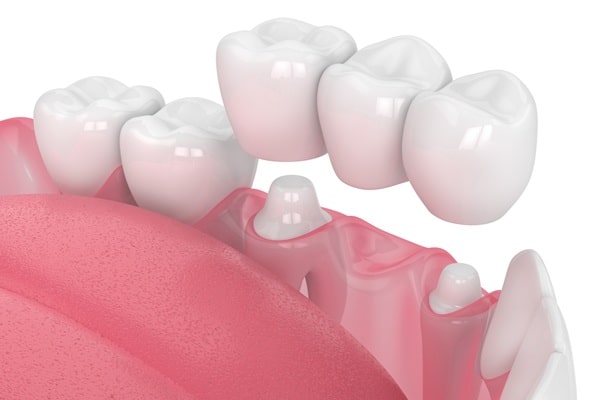 dental-bridges-in-surrey