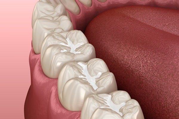 dental-fillings-in-surrey