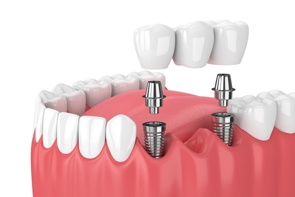 dental-implants-in-surrey
