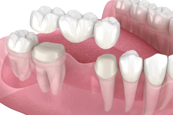 how-dental-bridges-work