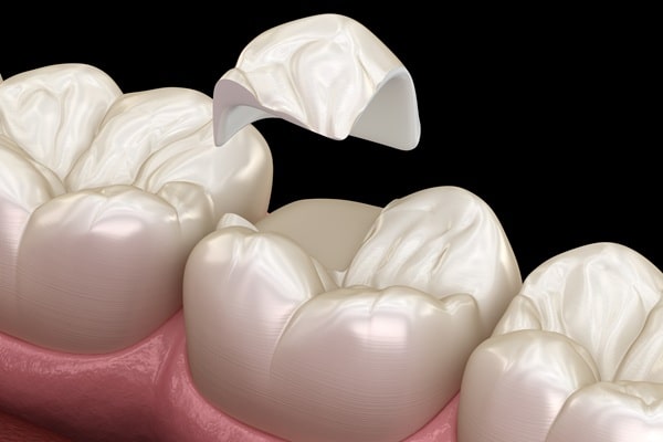 inlays-and-onlays-in-surrey