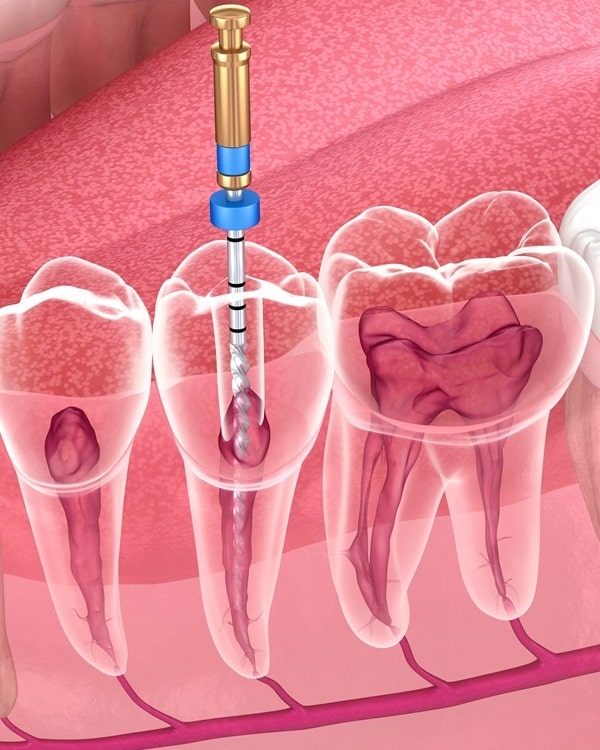 root-canals