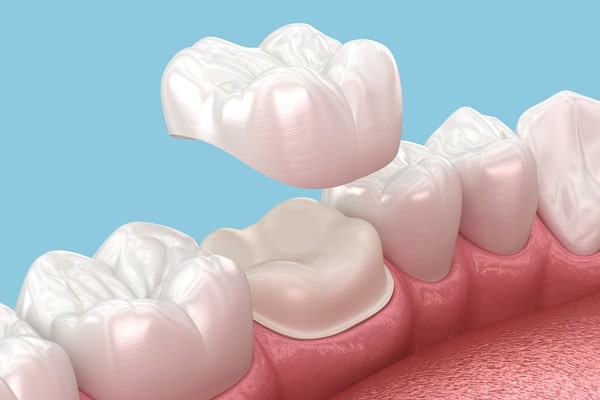 types-of-crowns-we-offer