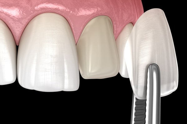 what-are-veneers