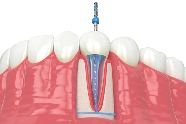 why-root-canals-are-needed